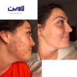 فوم شستشو صورت پوست نرمال تا چرب سراوی