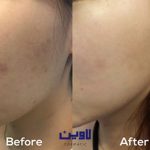 سرم ضدلک دارک اسپات اکسیس وای