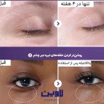 کرم دور چشم نامبوزین